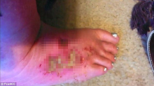 Πήγε σε σαλόνι ομορφιάς για πεντικιούρ και έφυγε με εγκαύματα γ' βαθμού [εικόνες & βίντεο] | iefimerida.gr 1