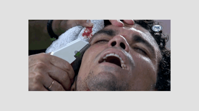 Σοκάρει η εικόνα του Πέπε μετά τον τραυματισμό του από παίκτη της Κοπεγχάγης-Η αιμορραγία του αμυντικού της Ρεάλ [βίντεο] | iefimerida.gr 0