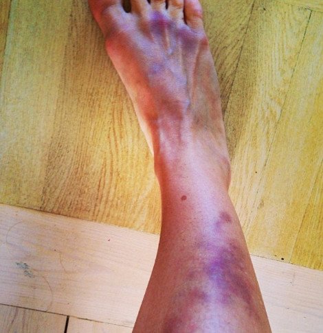 Το χτυπημένο και ακραία μελανιασμένο πόδι της πόσταρε στο Ιnstagram Ελληνίδα παρουσιάστρια [εικόνα] | iefimerida.gr 0