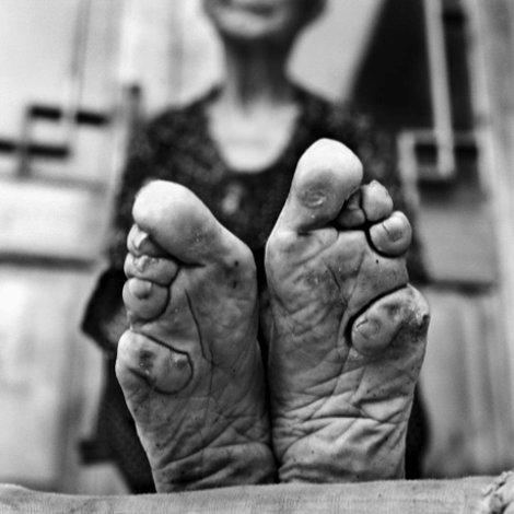 Τα πόδια του λωτού -Η αρχαία κινεζική αποτρόπαια παράδοση που άφησε ανάπηρες χιλιάδες γυναίκες [εικόνες] | iefimerida.gr 0