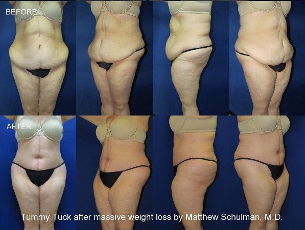 Πλαστικός χειρουργός ποστάρει στο Instagram φωτογραφίες από εγχειρίσεις οπισθίων [εικόνες] | iefimerida.gr 0