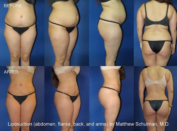 Πλαστικός χειρουργός ποστάρει στο Instagram φωτογραφίες από εγχειρίσεις οπισθίων [εικόνες] | iefimerida.gr 1