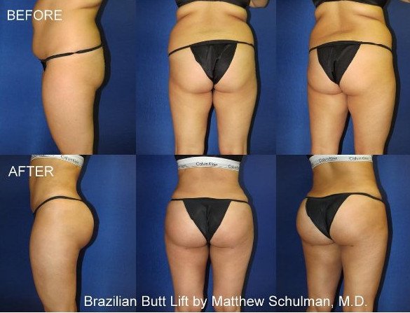 Πλαστικός χειρουργός ποστάρει στο Instagram φωτογραφίες από εγχειρίσεις οπισθίων [εικόνες] | iefimerida.gr 2