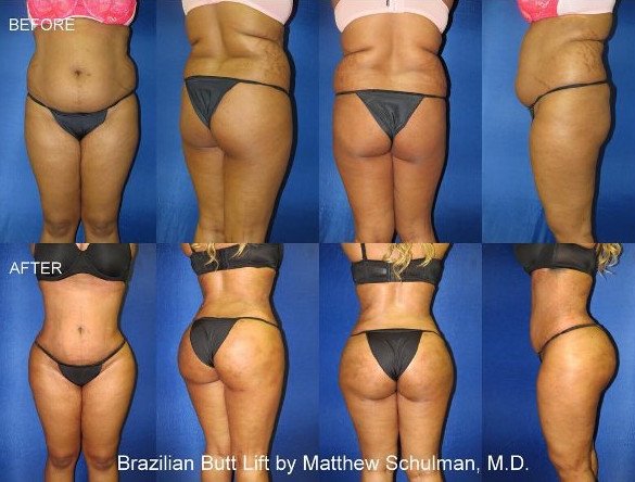 Πλαστικός χειρουργός ποστάρει στο Instagram φωτογραφίες από εγχειρίσεις οπισθίων [εικόνες] | iefimerida.gr 3