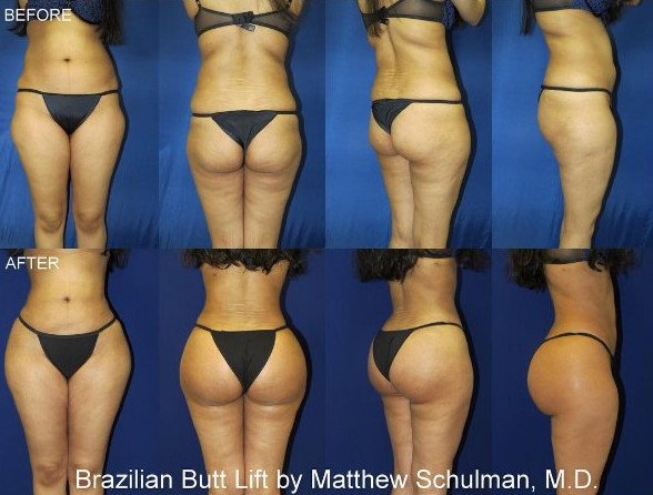 Πλαστικός χειρουργός ποστάρει στο Instagram φωτογραφίες από εγχειρίσεις οπισθίων [εικόνες] | iefimerida.gr 4