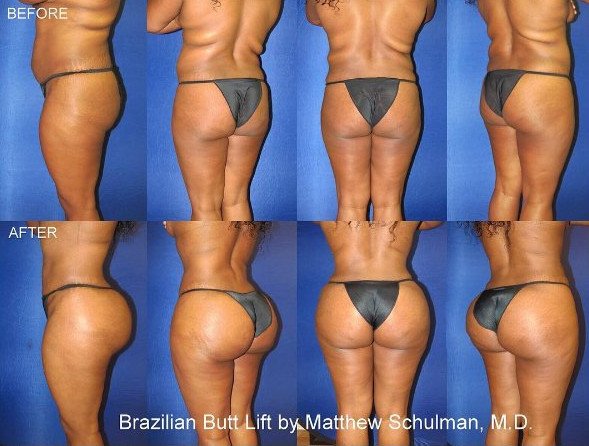 Πλαστικός χειρουργός ποστάρει στο Instagram φωτογραφίες από εγχειρίσεις οπισθίων [εικόνες] | iefimerida.gr 5