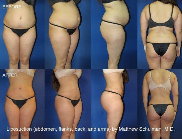 Πλαστικός χειρουργός ποστάρει στο Instagram φωτογραφίες από εγχειρίσεις οπισθίων [εικόνες] | iefimerida.gr 6