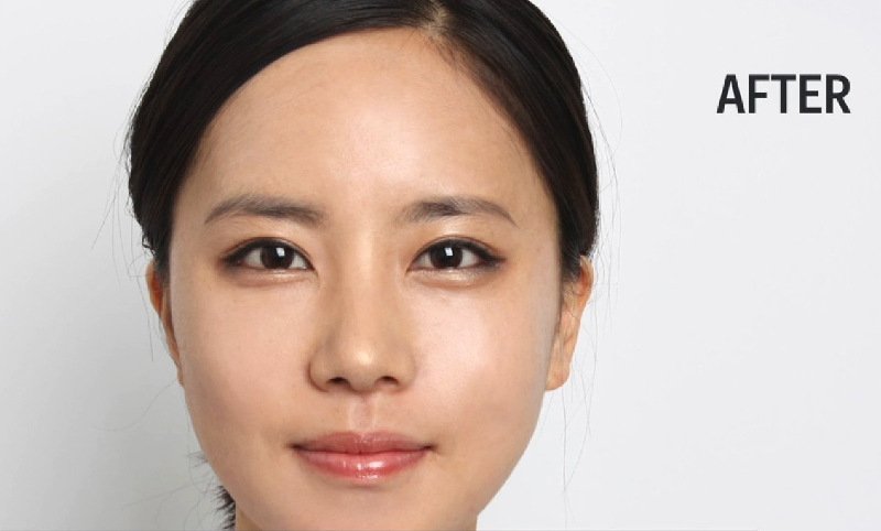 Νότια Κορέα: Βλεφαροπλαστική, η επέμβαση που κάνει θραύση [εικόνες] | iefimerida.gr 3