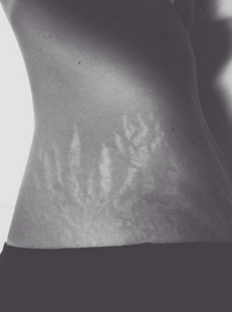 Περήφανες για τις «γραμμές» τους: Η σελίδα στο Instagram που πλημμύρισε με φωτογραφίες γυναικών έτσι όπως πραγματικά είναι -Γεμάτες ραγάδες [εικόνες] | iefimerida.gr 3