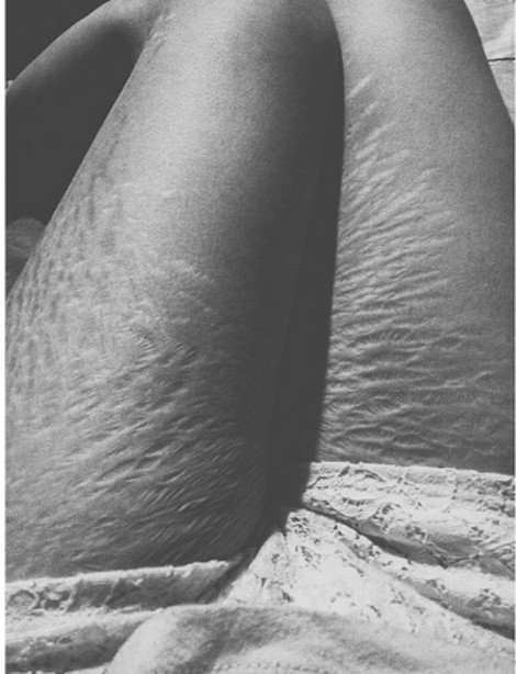 Περήφανες για τις «γραμμές» τους: Η σελίδα στο Instagram που πλημμύρισε με φωτογραφίες γυναικών έτσι όπως πραγματικά είναι -Γεμάτες ραγάδες [εικόνες] | iefimerida.gr 6