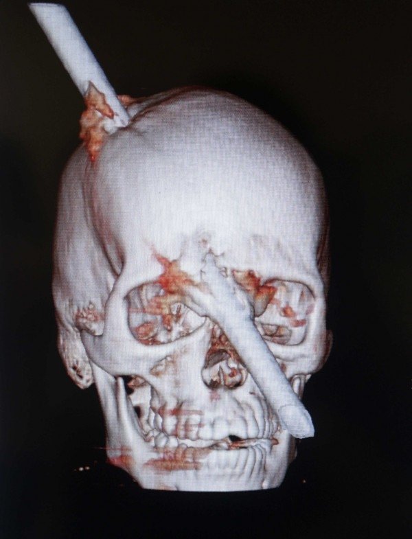 Του καρφώθηκε μία μεγάλη ράβδος στο κεφάλι αλλά αυτός επέζησε! [εικόνες] | iefimerida.gr 0