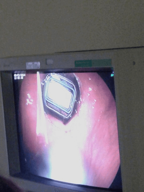 Απίστευτο: Γιατροί αφαίρεσαν από το στομάχι ασθενούς ένα ρολόι [εικόνες] | iefimerida.gr 0