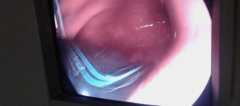 Απίστευτο: Γιατροί αφαίρεσαν από το στομάχι ασθενούς ένα ρολόι [εικόνες] | iefimerida.gr 1