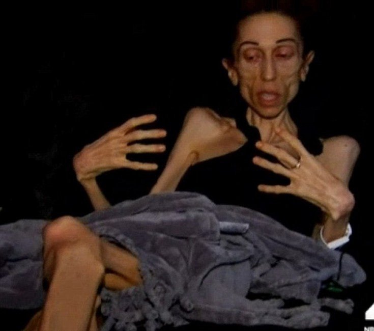 Η γυναίκα που ξαναγύρισε από την κόλαση: Εφτασε να ζυγίζει 18 κιλά – Σώθηκε την τελευταία στιγμή [εικόνες]  | iefimerida.gr 2