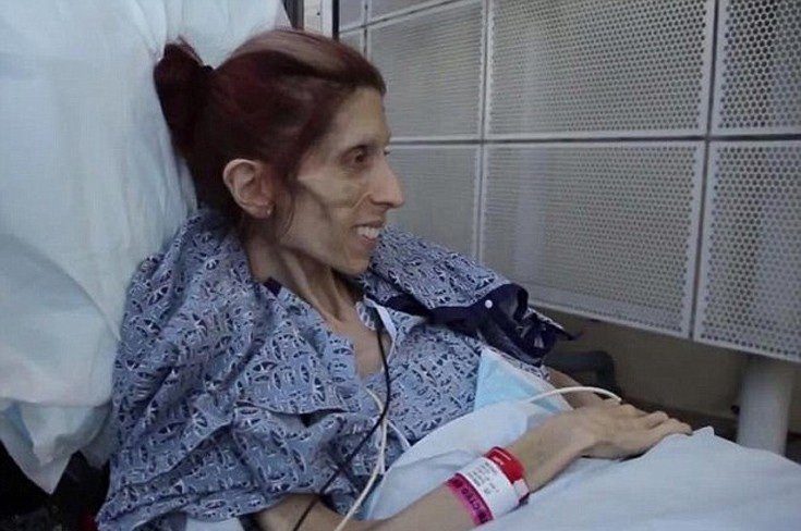 Η γυναίκα που ξαναγύρισε από την κόλαση: Εφτασε να ζυγίζει 18 κιλά – Σώθηκε την τελευταία στιγμή [εικόνες]  | iefimerida.gr 3