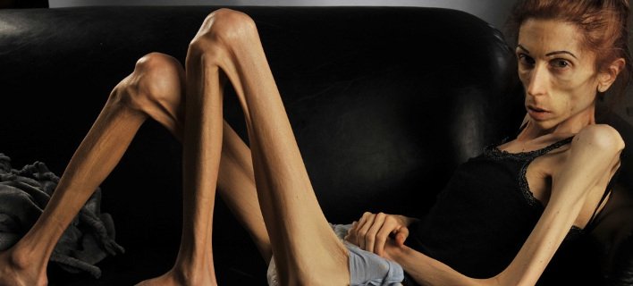 Η γυναίκα που ξαναγύρισε από την κόλαση: Εφτασε να ζυγίζει 18 κιλά – Σώθηκε την τελευταία στιγμή [εικόνες]  | iefimerida.gr 0