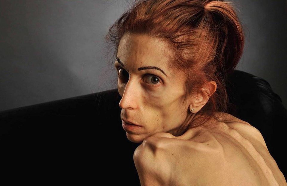 Η γυναίκα που ξαναγύρισε από την κόλαση: Εφτασε να ζυγίζει 18 κιλά – Σώθηκε την τελευταία στιγμή [εικόνες]  | iefimerida.gr 1