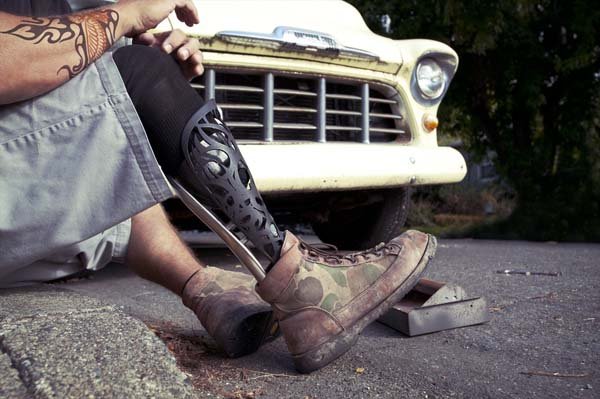 Η ζωή με ένα πρόσθετο τεχνητό μέλος-Σκληρά στιγμιότυπα από ανθρώπινες τραυματικές εμπειρίες [εικόνες]  | iefimerida.gr 2