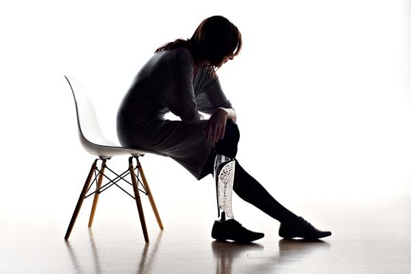 Η ζωή με ένα πρόσθετο τεχνητό μέλος-Σκληρά στιγμιότυπα από ανθρώπινες τραυματικές εμπειρίες [εικόνες]  | iefimerida.gr 8