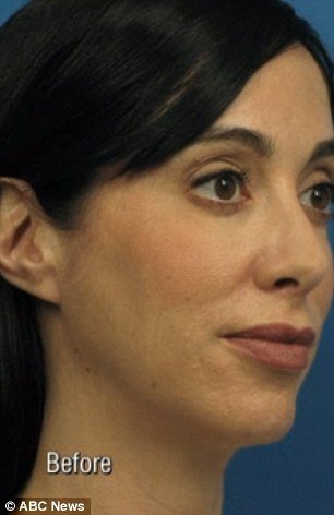 Μια αρρωστημένη εμμονή: Ξόδεψε 15.000 δολάρια σε πλαστικές εγχειρήσεις για να βγάζει καλύτερες selfies [εικόνες] | iefimerida.gr 2