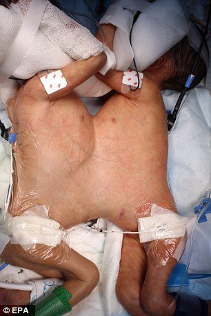 Διαχώρισαν σιαμαία 8 ημερών -Τα μικρότερα στον κόσμο  [εικόνες] | iefimerida.gr 0