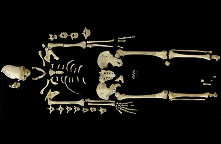 Την αρχαιότερη περίπτωση λευχαιμίας ανακάλυψαν οι επιστήμονες -Σε σκελετό 7.000 ετών [εικόνα] | iefimerida.gr 0