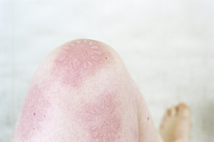 Εκανε τέχνη τη σπάνια πάθησή της και σαρώνει -Η πανέμορφη καλλιτέχνιδα με το σημαδεμένο σώμα [εικόνες] | iefimerida.gr 1