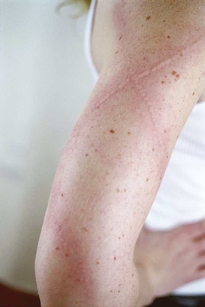 Εκανε τέχνη τη σπάνια πάθησή της και σαρώνει -Η πανέμορφη καλλιτέχνιδα με το σημαδεμένο σώμα [εικόνες] | iefimerida.gr 5