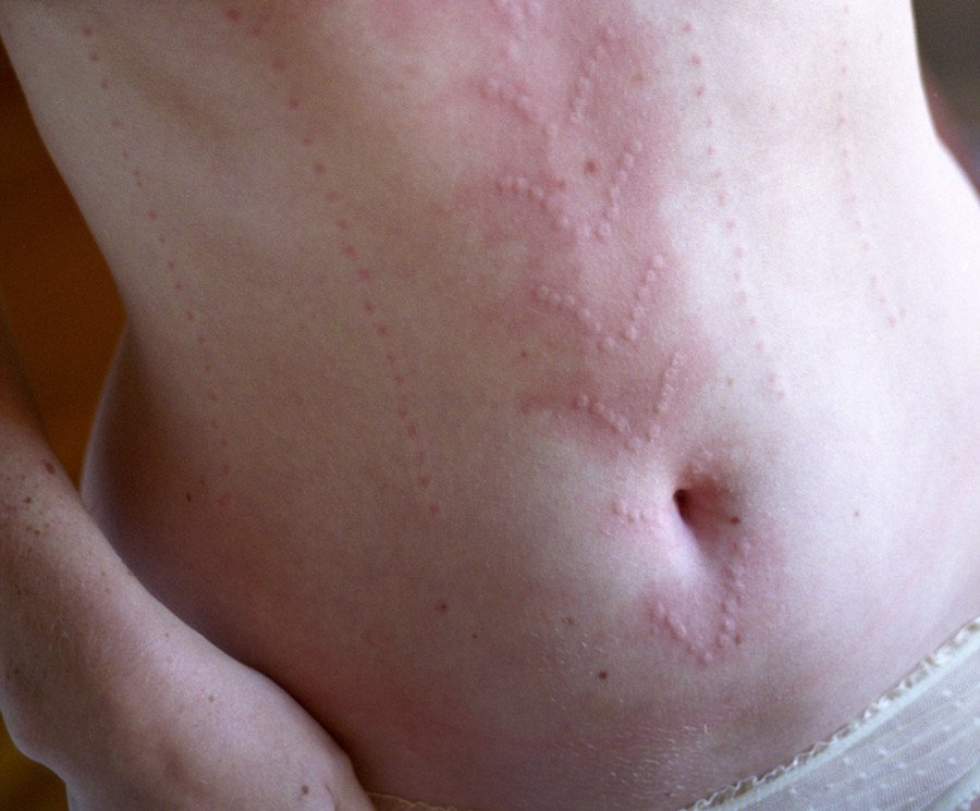 Εκανε τέχνη τη σπάνια πάθησή της και σαρώνει -Η πανέμορφη καλλιτέχνιδα με το σημαδεμένο σώμα [εικόνες] | iefimerida.gr 0