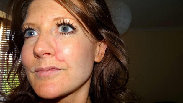 Εκανε 900 ώρες ηλιοθεραπείας και της αφαίρεσαν μέρος του προσώπου -Σοκάρει 33χρονη καρκινοπαθής [εικόνες] | iefimerida.gr 0