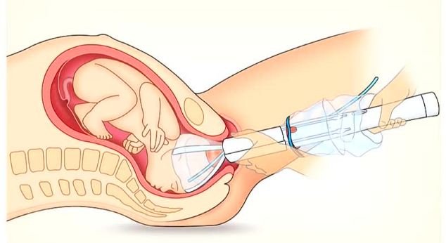 Εφεύρεση που κάνει τον τοκετό παιχνιδάκι -Ο δαιμόνιος Αργεντινός που εμπνεύστηκε από έναν ... φελλό [εικόνες] | iefimerida.gr 3