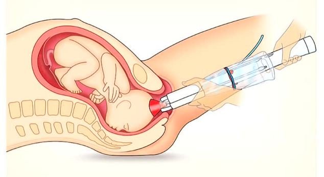 Εφεύρεση που κάνει τον τοκετό παιχνιδάκι -Ο δαιμόνιος Αργεντινός που εμπνεύστηκε από έναν ... φελλό [εικόνες] | iefimerida.gr 2