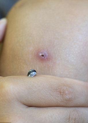 Θαλάσσιο σαλιγκάρι εκκολάφτηκε μέσα από πληγή στο πόδι ενός τετράχρονου αγοριού [εικόνες] | iefimerida.gr 0