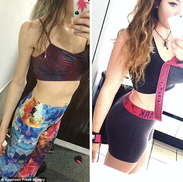 Η απίστευτη μεταμόρφωση ανορεξικής φοιτήτριας -Ηταν σκελετός, τώρα φουσκωμένη από τα βάρη [εικόνες] | iefimerida.gr 5