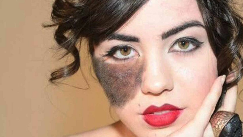 Πώς μια καλλονή με τριχωτό σημάδι εκ γενετής αγάπησε την ιδιαιτερότητά της και έγινε χορεύτρια [εικόνες]  | iefimerida.gr 1