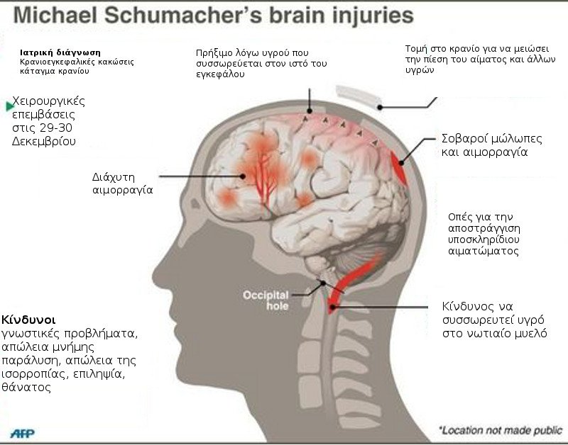 Το διάγραμμα των κρανιοεγκεφαλικών κακώσεων του Μίκαελ Σουμάχερ -Με τι βρίσκεται πλέον αντιμέτωπος [εικόνα] | iefimerida.gr 0