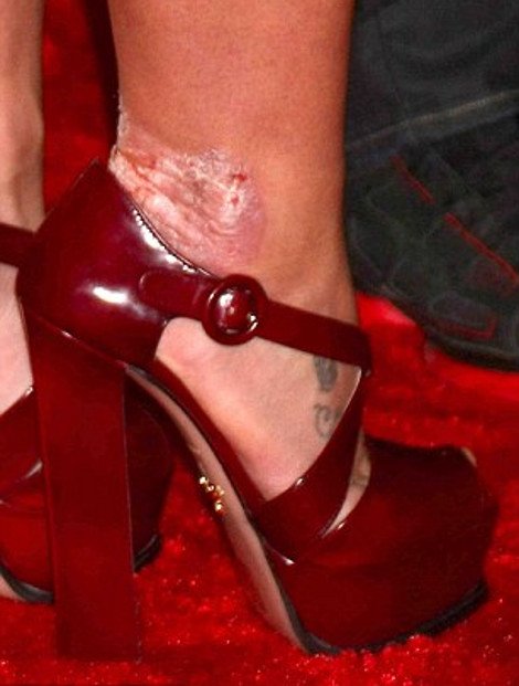 Τα εμφανή σημάδια της ψωρίασης στο σώμα της Μπρίτνεϊ Σπίαρς [εικόνες] | iefimerida.gr 0