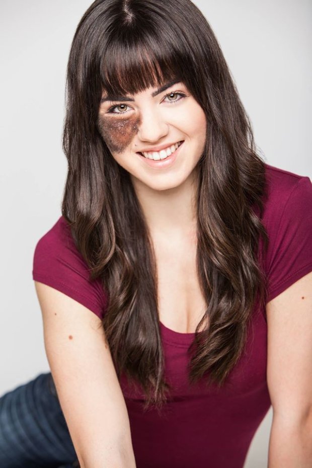 Πώς μια καλλονή με τριχωτό σημάδι εκ γενετής αγάπησε την ιδιαιτερότητά της και έγινε χορεύτρια [εικόνες]  | iefimerida.gr 0