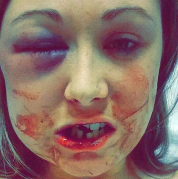 Της έσπασε το σαγόνι και τρία δόντια επειδή δεν ήθελε σεξ μαζί του [σκληρές εικόνες] | iefimerida.gr 2