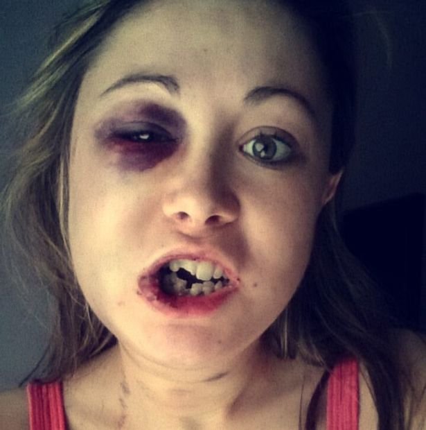 Της έσπασε το σαγόνι και τρία δόντια επειδή δεν ήθελε σεξ μαζί του [σκληρές εικόνες] | iefimerida.gr 4