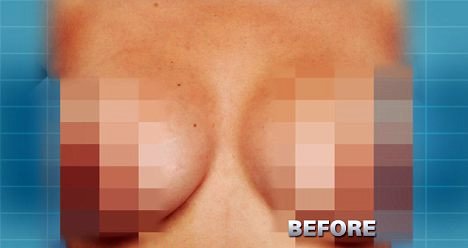 Αντί να της μεγαλώσουν το στήθος της το ένωσαν! [εικόνες] | iefimerida.gr 0