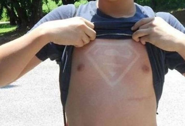 Η νέα επικίνδυνη μόδα: Κάθονται στο ήλιο για να κάνουν εγκαύματα με σχέδια [εικόνες] | iefimerida.gr 5