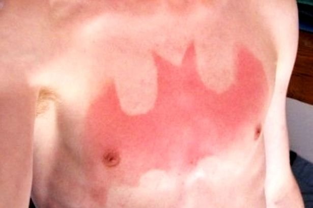 Η νέα επικίνδυνη μόδα: Κάθονται στο ήλιο για να κάνουν εγκαύματα με σχέδια [εικόνες] | iefimerida.gr 2