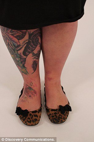 Κινδύνευσε να χάσει το πόδι της εξαιτίας ενός τατουάζ - Υπέστη δηλητηρίαση αίματος και σηψαιμία [εικόνες]   | iefimerida.gr 1