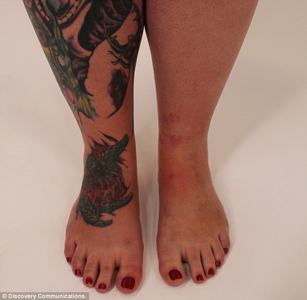 Κινδύνευσε να χάσει το πόδι της εξαιτίας ενός τατουάζ - Υπέστη δηλητηρίαση αίματος και σηψαιμία [εικόνες]   | iefimerida.gr 2