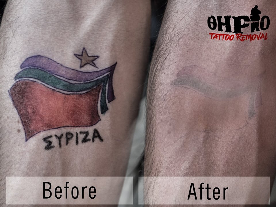Είχε χτυπήσει τατουάζ... ΣΥΡΙΖΑ – Πήγε και το αφαίρεσε [εικόνες] | iefimerida.gr 1