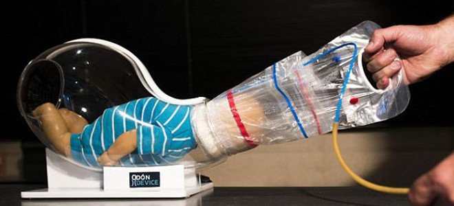 Εφεύρεση που κάνει τον τοκετό παιχνιδάκι -Ο δαιμόνιος Αργεντινός που εμπνεύστηκε από έναν ... φελλό [εικόνες] | iefimerida.gr 0