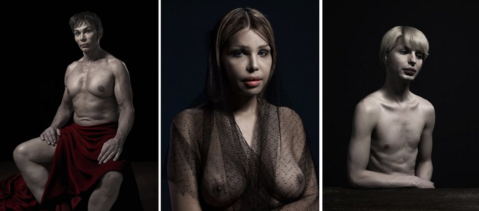 H υπερβολή στο πετσί τους -Ακραίες πλαστικές επεμβάσεις στο φακό του φωτογράφου [εικόνες] | iefimerida.gr 2