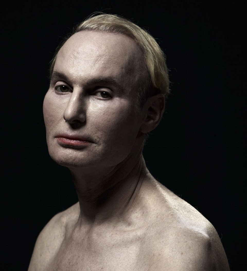 H υπερβολή στο πετσί τους -Ακραίες πλαστικές επεμβάσεις στο φακό του φωτογράφου [εικόνες] | iefimerida.gr 5