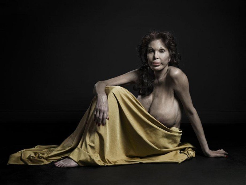 H υπερβολή στο πετσί τους -Ακραίες πλαστικές επεμβάσεις στο φακό του φωτογράφου [εικόνες] | iefimerida.gr 15